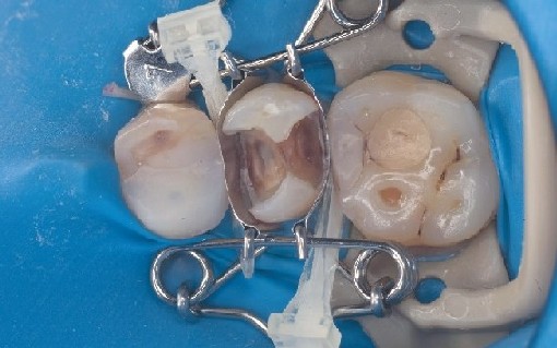 Zahn-Matrize sitzt perfekt auf Prämolar und bildet dabei automatisch eine schöne Formgebung der einzusetzenden Kompositfüllung.