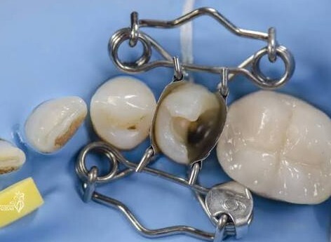 Walser dental matrix on the premolar – clinical application